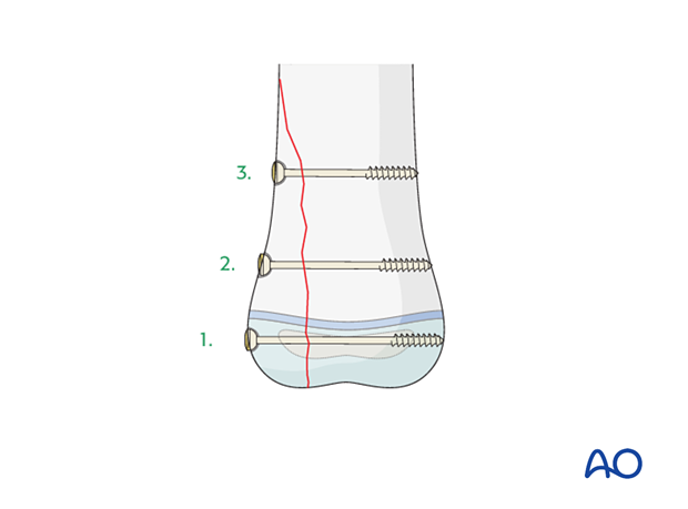 Order of screw insertion in Salter-Harris IV fractures