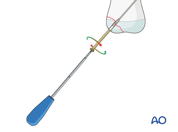 Manual screw insertion