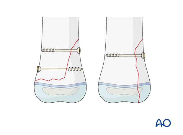 Fixation of large metaphyseal fragments