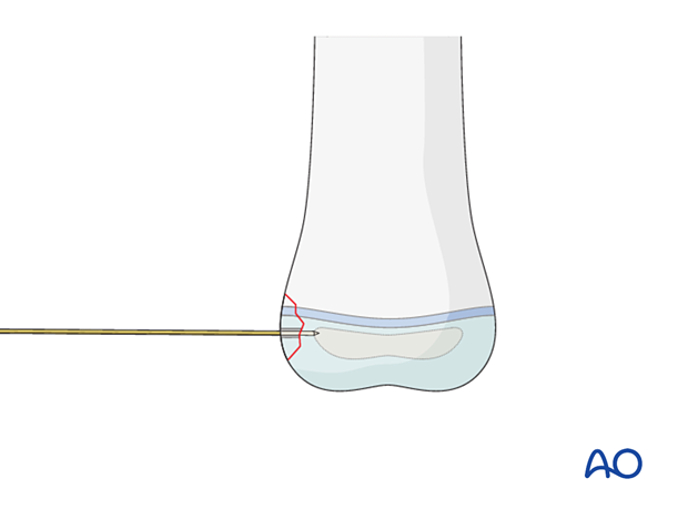 Entry point of guide wire