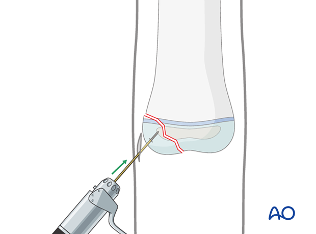 Guide wire used for reduction