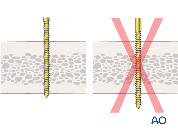 Pin insertion (conventional threaded pins)