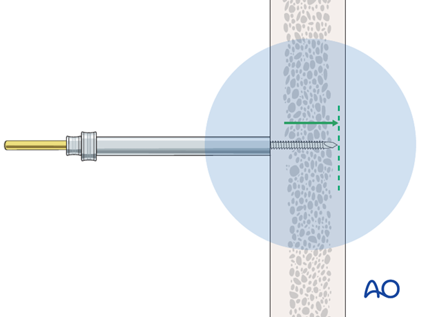 Pin insertion (self-drilling Schanz screws)