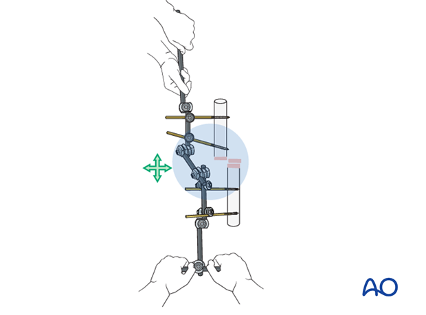 Pearl: lengthening the lever arm