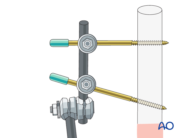 Pearl: shortening the pins