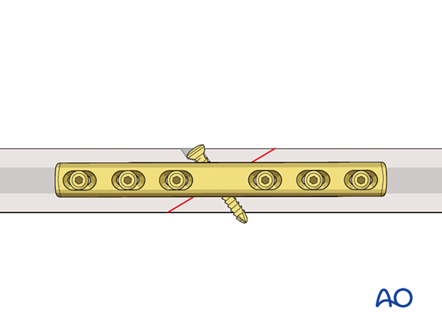 Lag screw fixation of an oblique shaft fracture protected by a neutralization plate