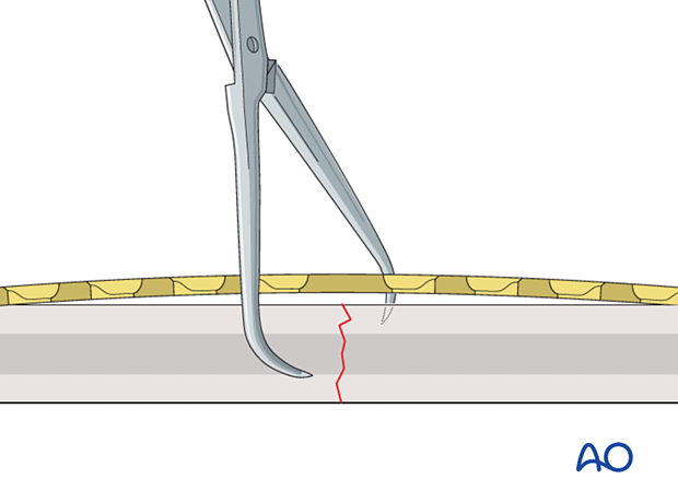 Reduced transverse shaft fracture with an overbent plate applied