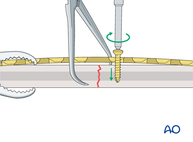 Insertion of the first screw for compression plating of a transverse shaft fracture