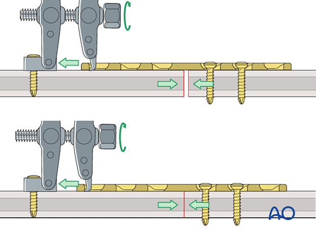 Compression using an articulated tension device in a transverse shaft fracture