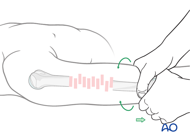 Manual reduction in length and rotation of a humeral shaft fracture