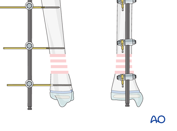 Use of external fixation for redution of a fracture of the pediatreic distal tibia