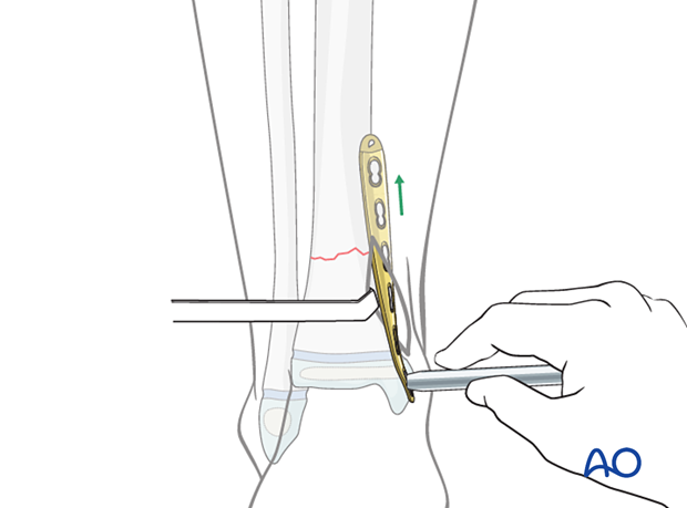 Plate insertion in MIPO of a simple fracture of the pediatric distal tibia