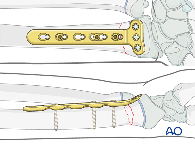 Butress plating of a simple metaphyseal fracture of the pediatric distal radius