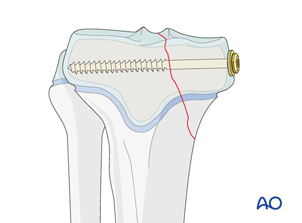 Lag screw insertion in a partial articular fracture of the pediatric proximal tibia