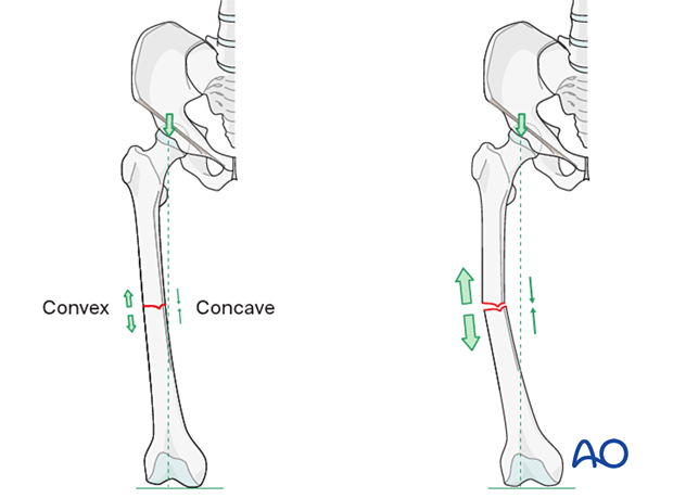 The convex side of the bone is under tension and the concave side is under compression.