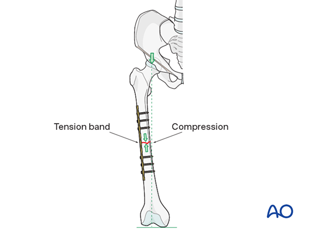 Tension bands convert tensile load into compressive load.