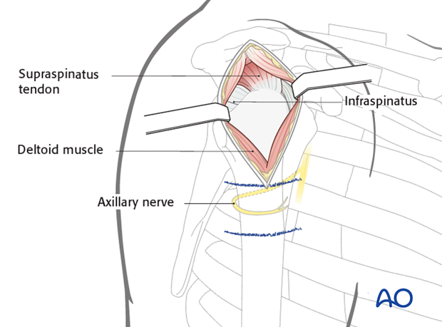 Exposure of the middle third part of the deltoid muscle