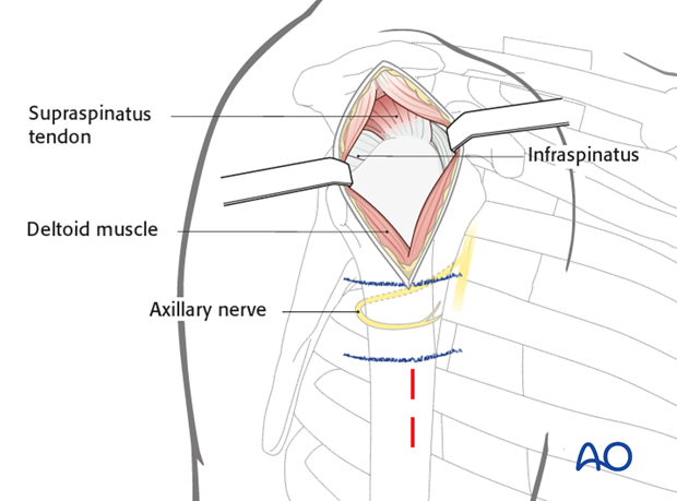 Transdeltoid lateral approach