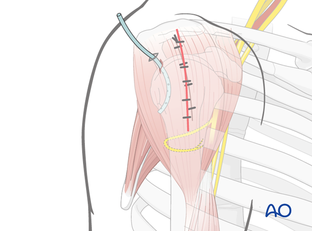 Wound closure