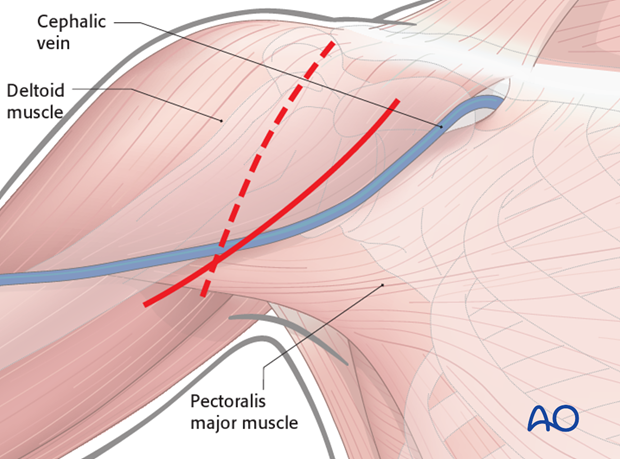 deltopectoral approach to the proximal humerus