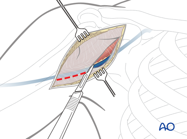 deltopectoral approach to the proximal humerus