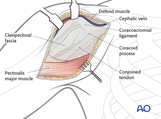 deltopectoral approach to the proximal humerus