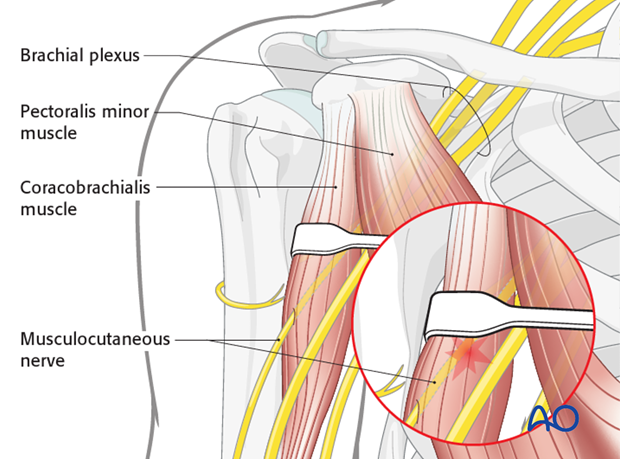 deltopectoral approach to the proximal humerus