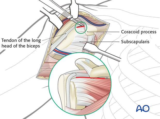 deltopectoral approach to the proximal humerus