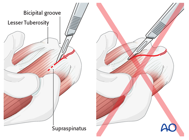 deltopectoral approach to the proximal humerus