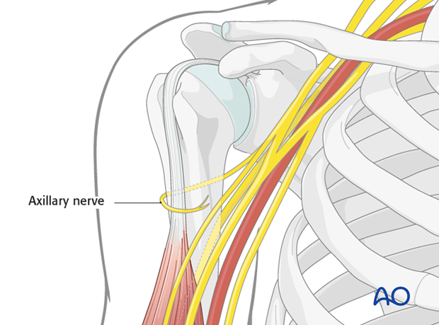 anterolateral approach