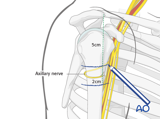 anterolateral approach