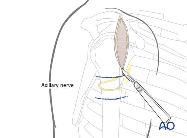 anterolateral approach