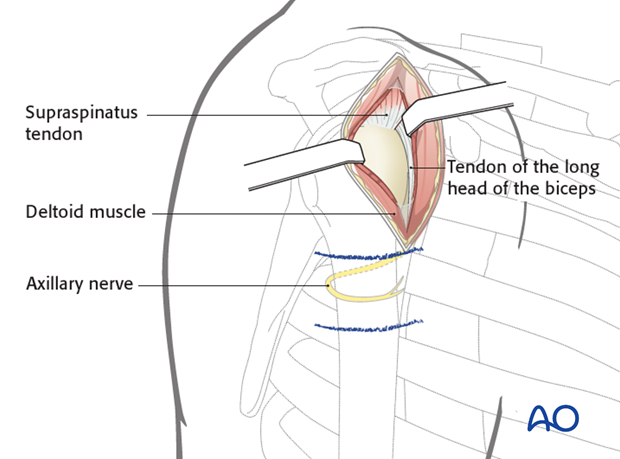 anterolateral approach