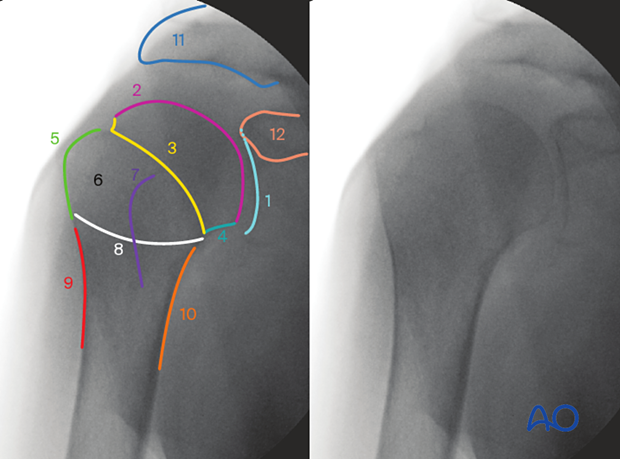 Anatomical lines and landmarks in AP view of the shoulder