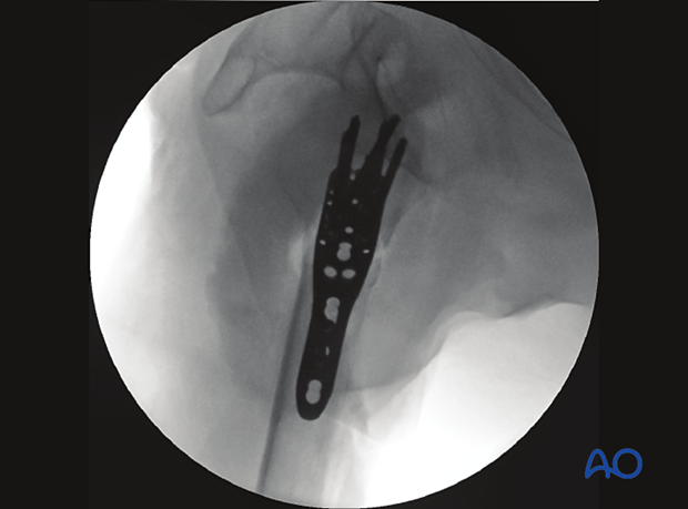 Lateral view of a proximal humeral fracture with plate fixation