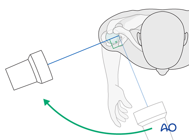 Positioning for optimal scapular-Y view of the proximal humerus