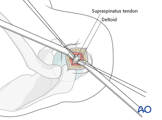 Exposure of the humerus