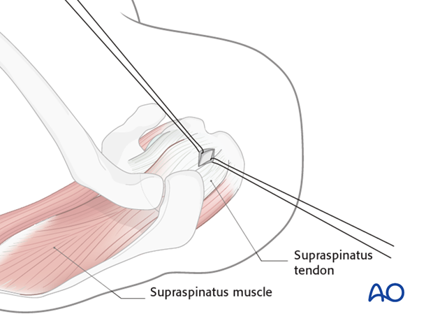 Pitfall: Damage to rotator cuff