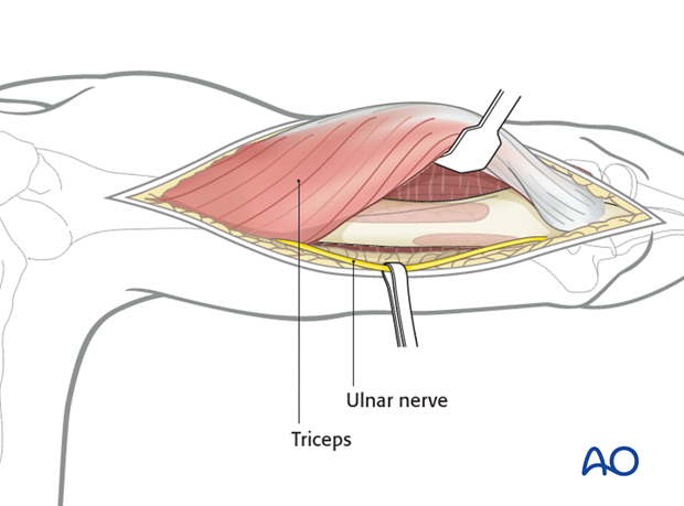 For midshaft and distal shaft fractures, the posterior approach may be extended distally, leaving the triceps insertion intact.