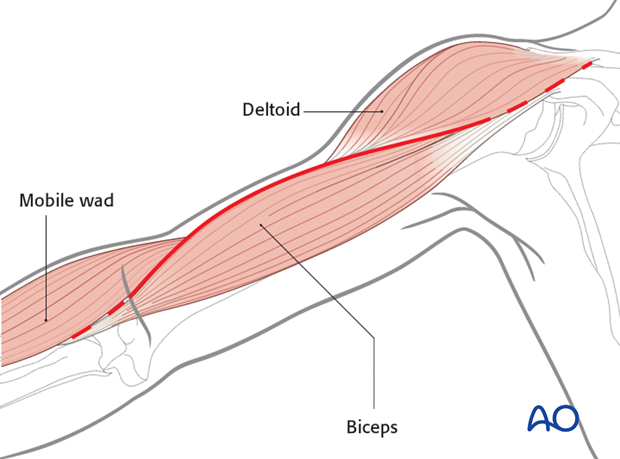 Anterolateral approach to the humerus (after Henry)