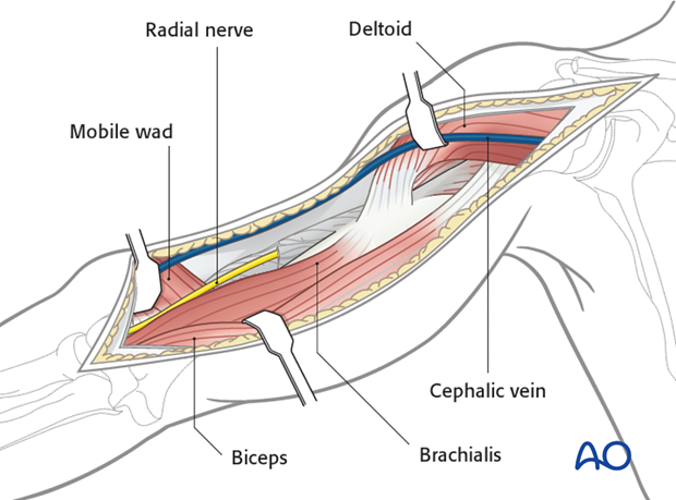 Retract the biceps medially, and the mobile wad laterally.