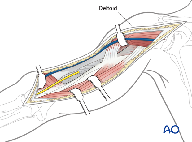 Alternatively, the brachialis may be retracted medially.