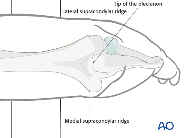 The retrograde nailing approach allows an almost inline opening of the medullary canal just proximal to the olecranon fossa.