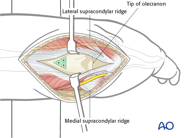 The retrograde nailing approach allows an almost inline opening of the medullary canal just proximal to the olecranon fossa.