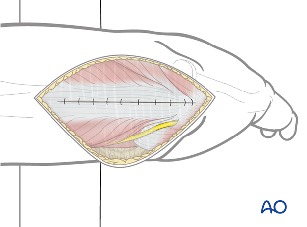 Close the incised triceps tendon and the posterior fascia of the upper arm with sutures in layers.