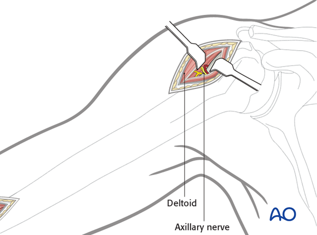 Proximal portal (anterior deltoid split)