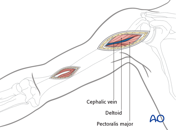 Proximal portal (deltobicipital)