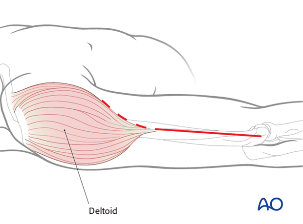 Lateral approach to the humeral shaft