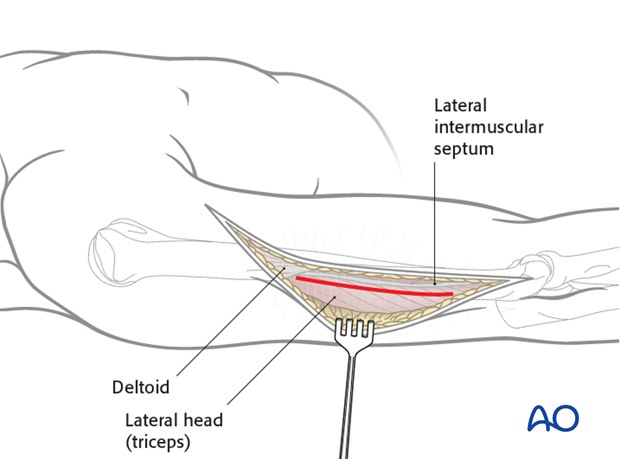 Superficial dissection