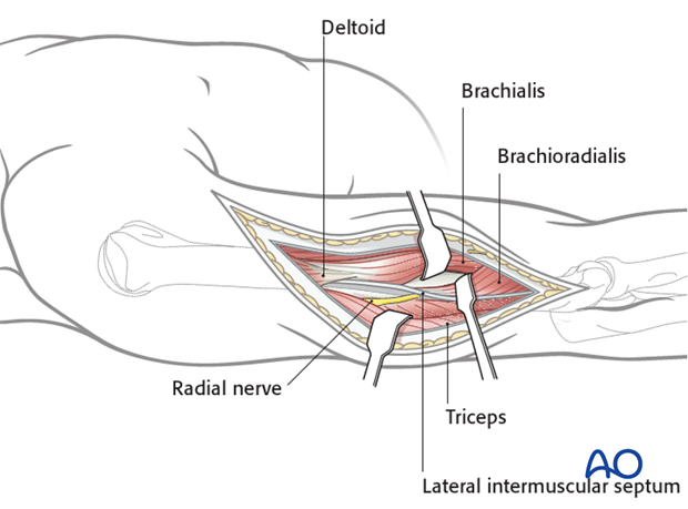 Deep dissection